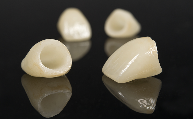 人工歯の美しさを追求できる審美修復治療