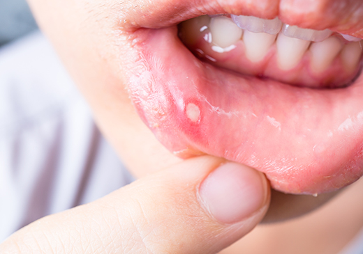 治りが遅いお口のデキモノは要注意