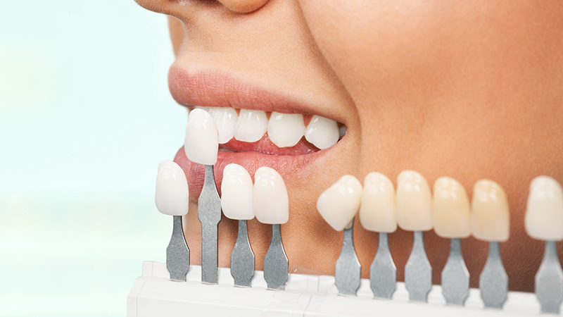 ホワイトニングについて